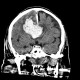 Intracerebral hemorrhage, semioval center: CT - Computed tomography